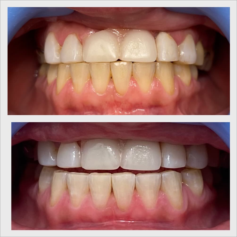 Teeth whitening before and after result - Client 1