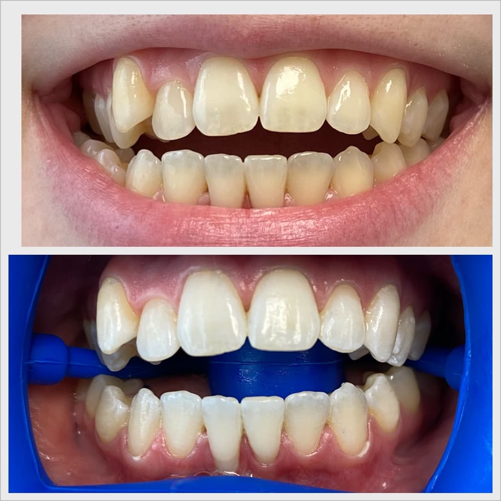 Teeth whitening before and after result - Client 4