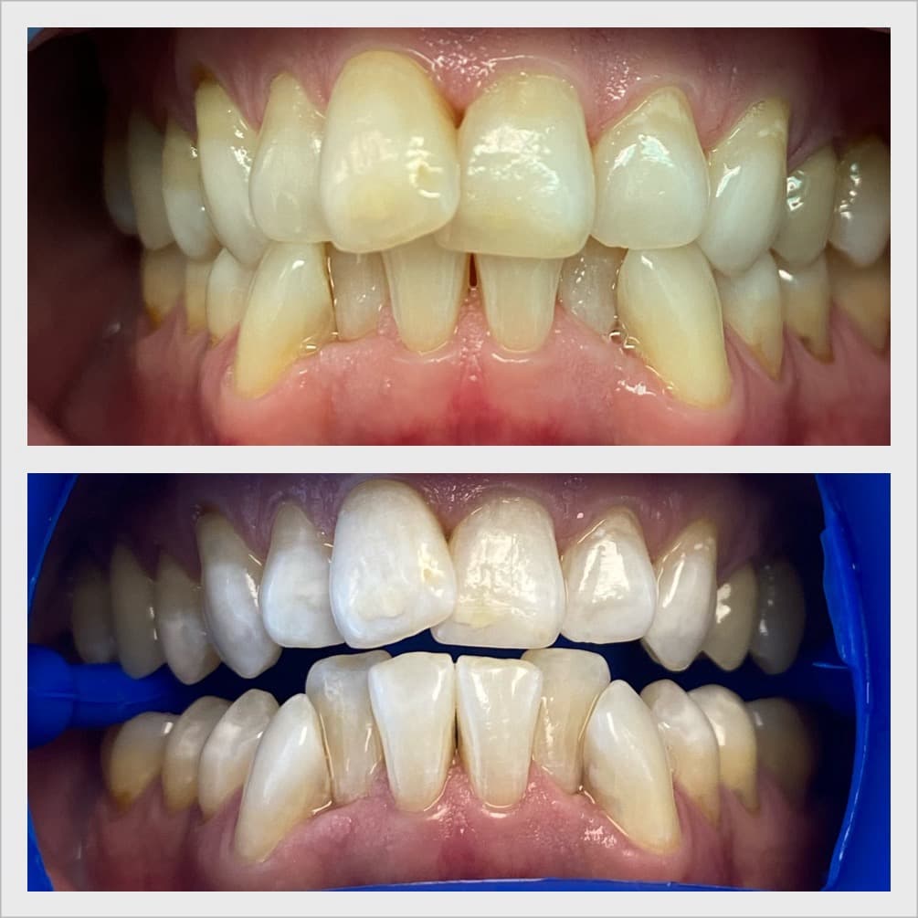 Teeth whitening before and after result - Client 5