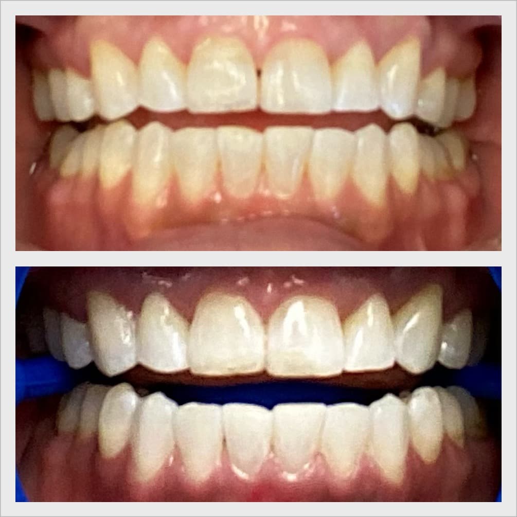 Teeth whitening before and after result - Client 6