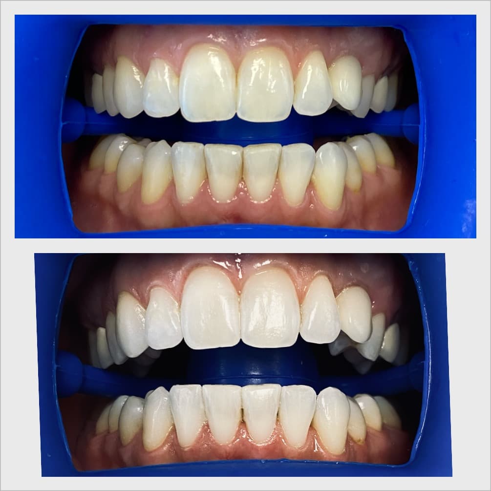 Teeth whitening before and after result - Client 7