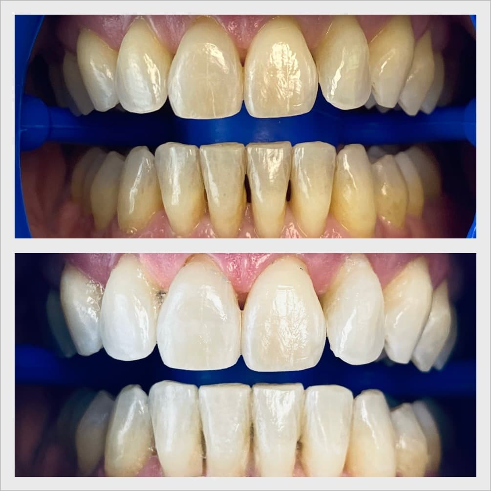 Teeth whitening before and after result - Client 8