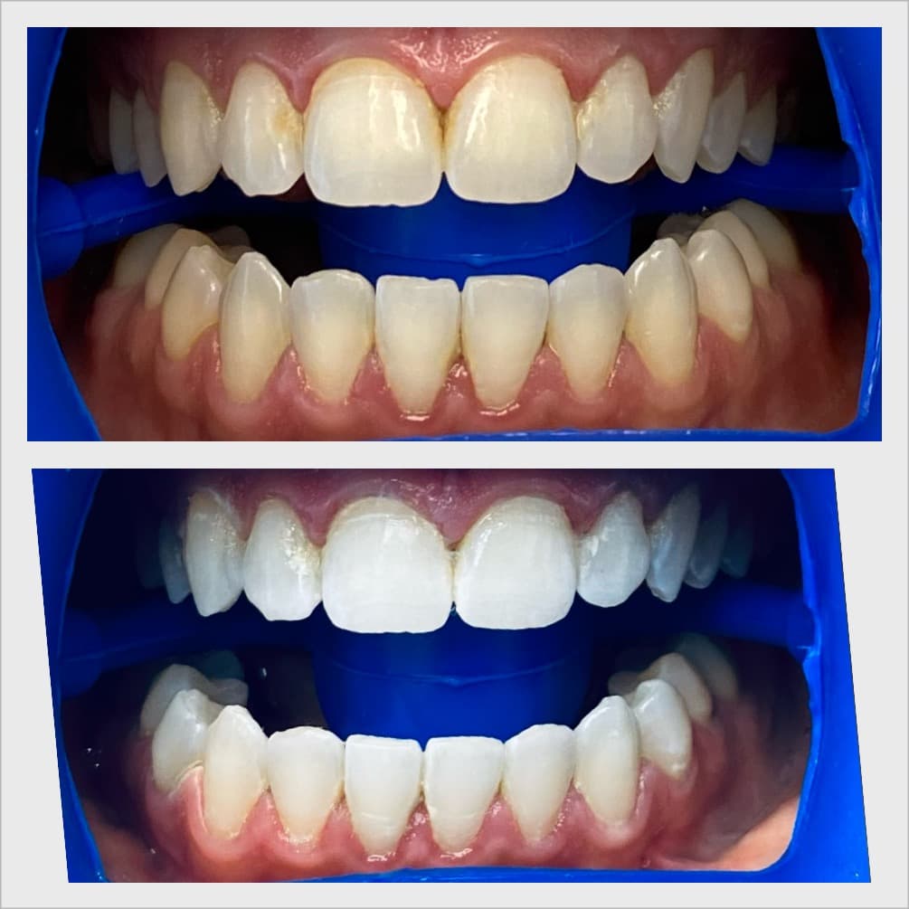 Teeth whitening before and after result - Client 9