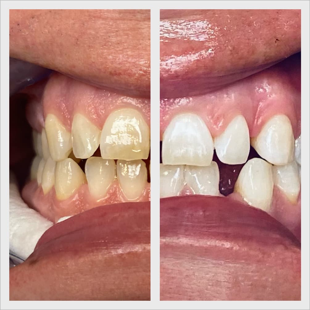 Teeth whitening before and after result - Client 10