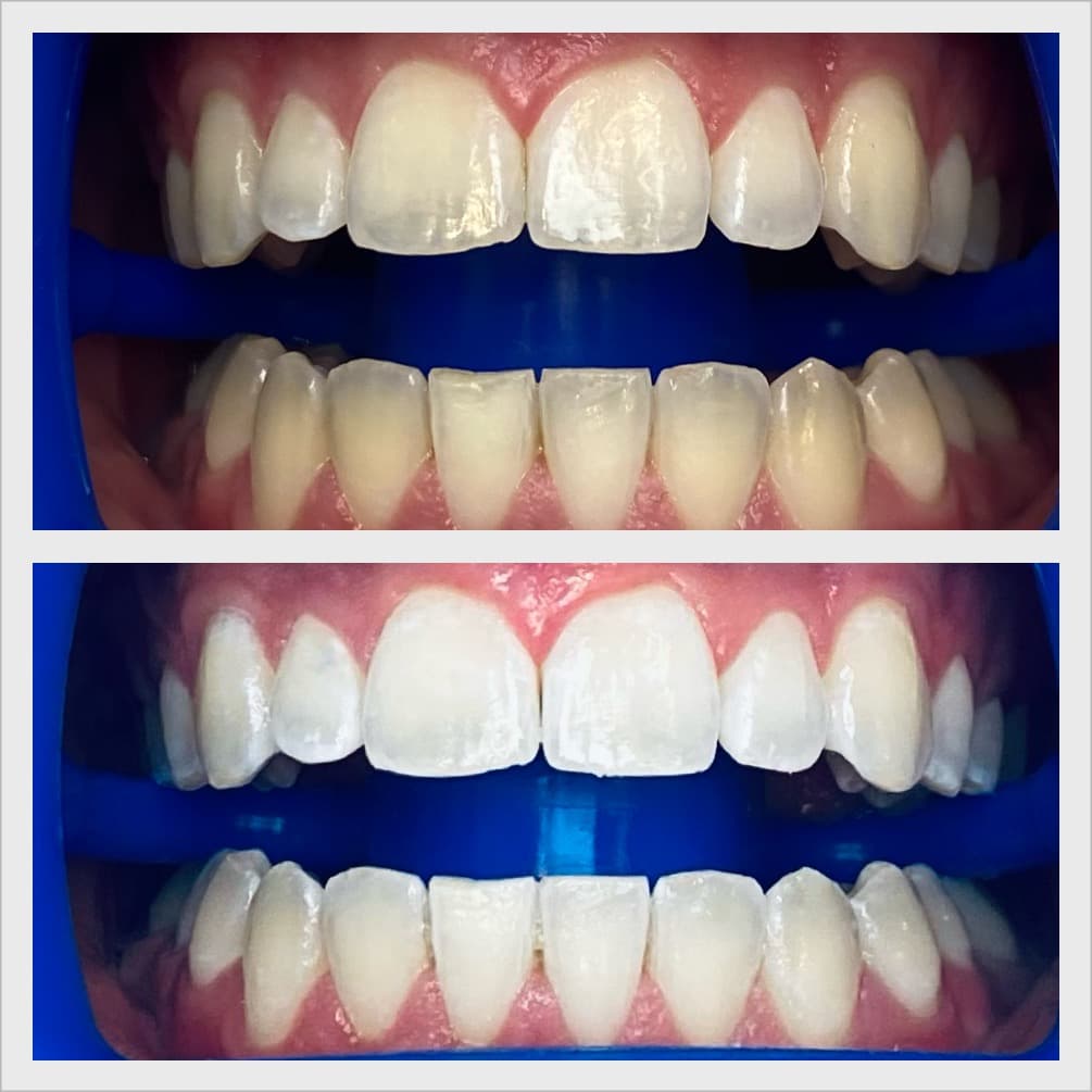 Professional teeth whitening result