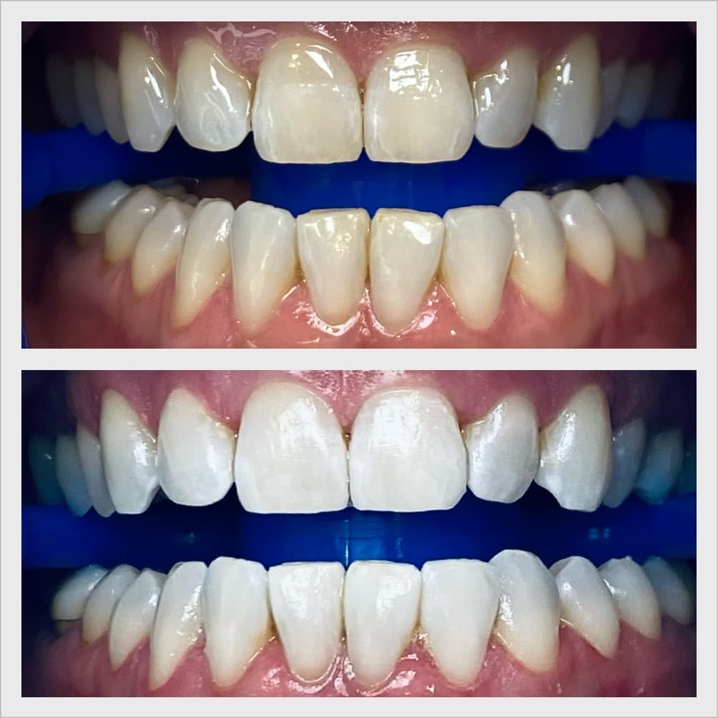 Bright white smile after treatment