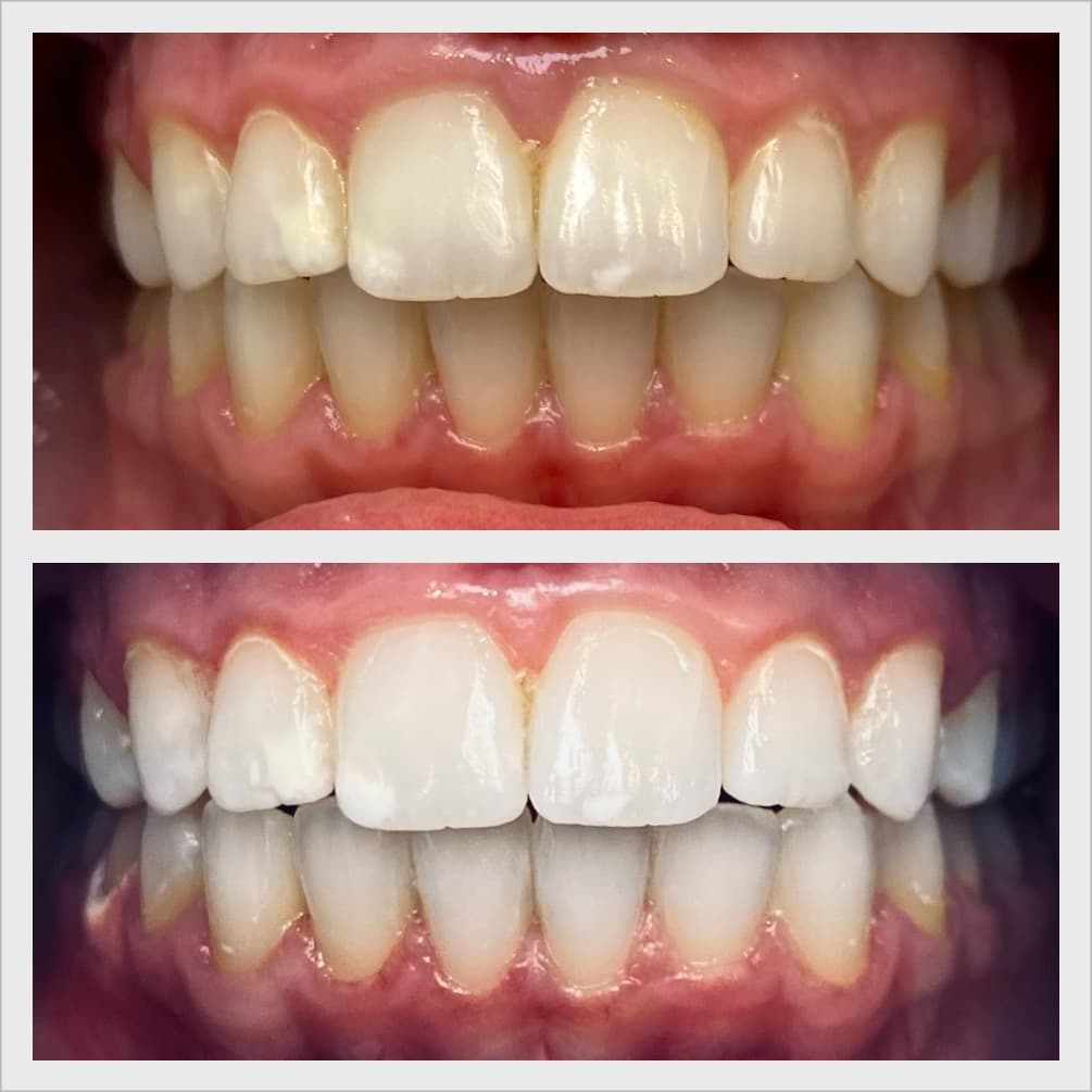 Teeth whitening transformation