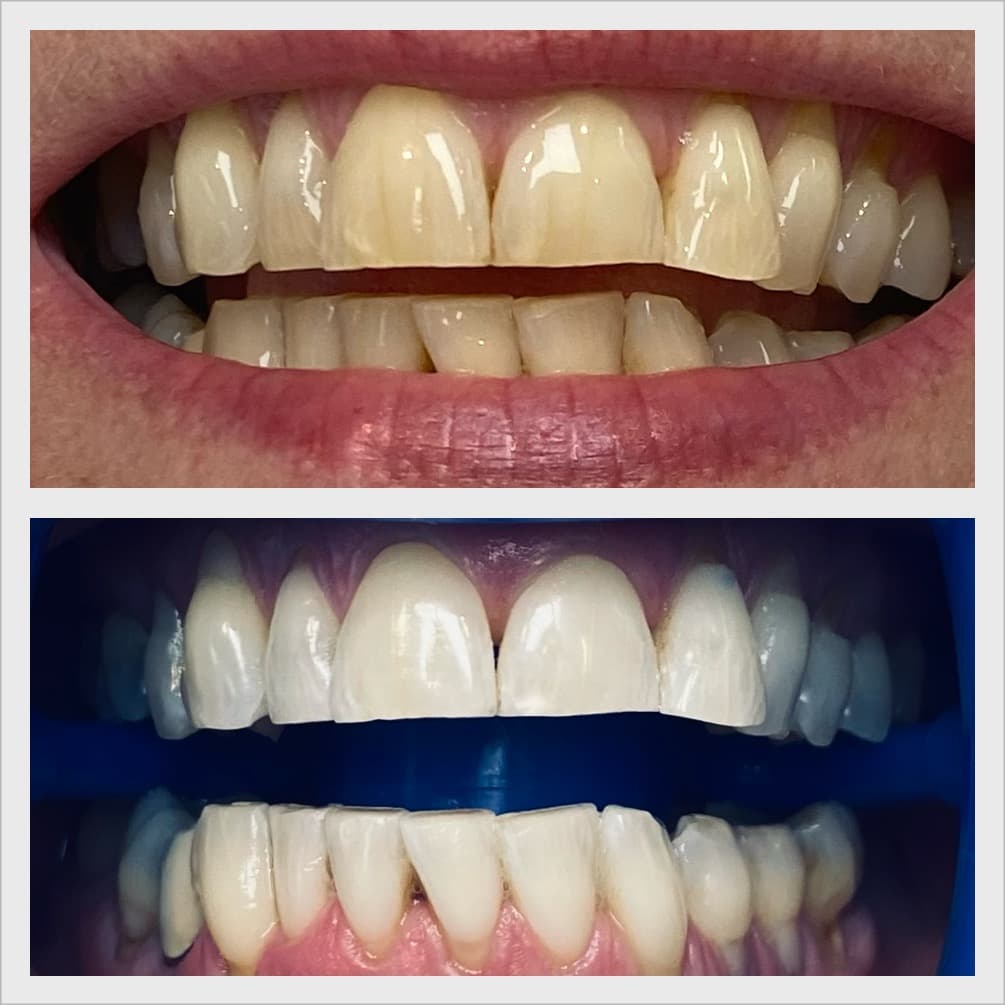 Beautiful smile after professional whitening